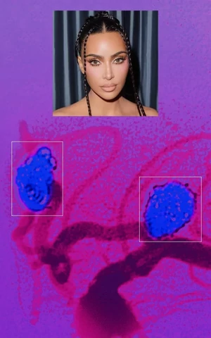 У Ким Кардашьян нашли аневризму головного мозга. Виноват Канье Уэст или это может случиться с каждым? 