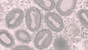 В Подмосковье выявили случай заражения оспой обезьян. Что известно о новой вспышке